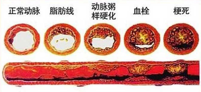 血栓在哪，病就在哪！該怎么清除血栓呢？