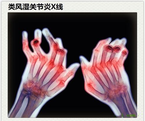 類(lèi)風(fēng)濕性關(guān)節(jié)炎真的是“不死的癌癥”？