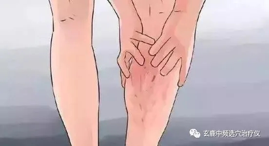 治療靜脈曲張，中醫(yī)有良方，一根針讓你告別“蚯蚓”腿