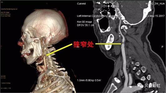 頸椎病都是“積”出來(lái)的，4個(gè)傷頸的行為，別總是做